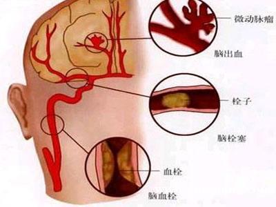 脑梗塞、脑血栓、脑出血